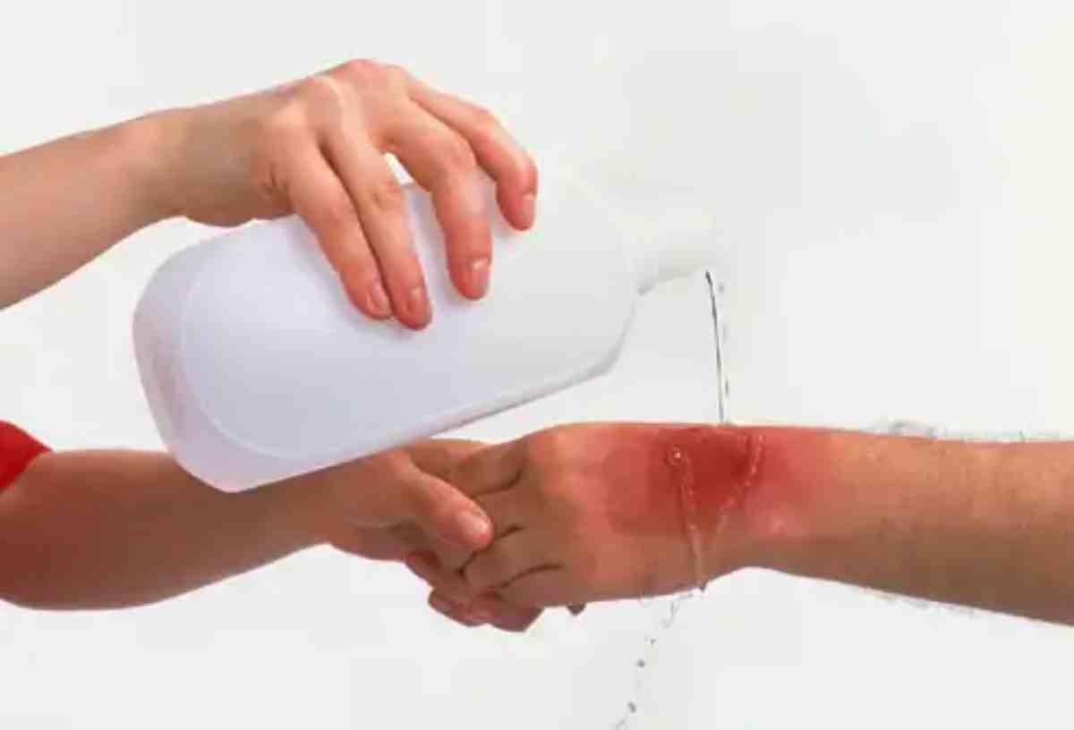 إسعاف الحروق: 7 خطوات اساسية